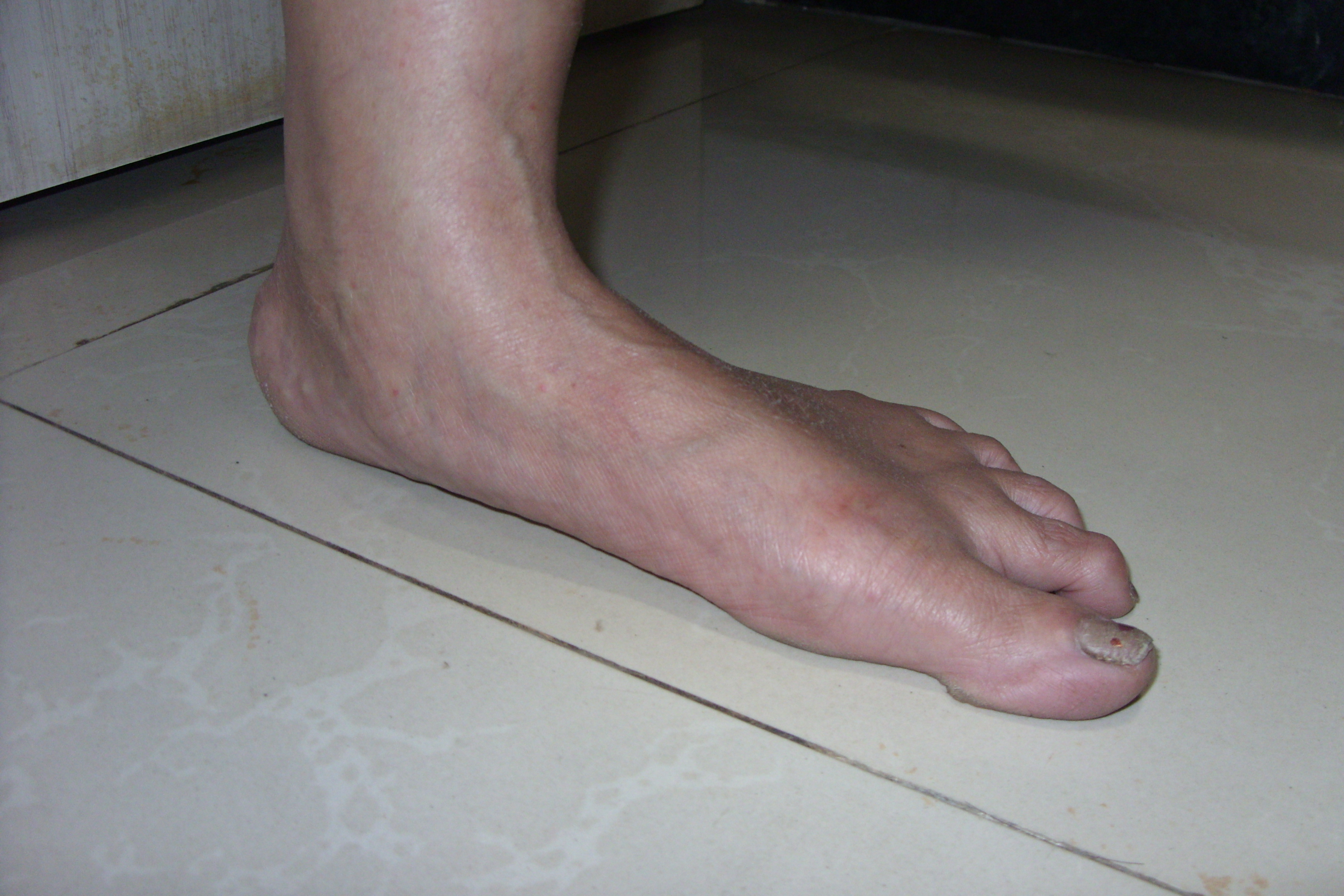 Adult flat foot showing the collapsed medial arch