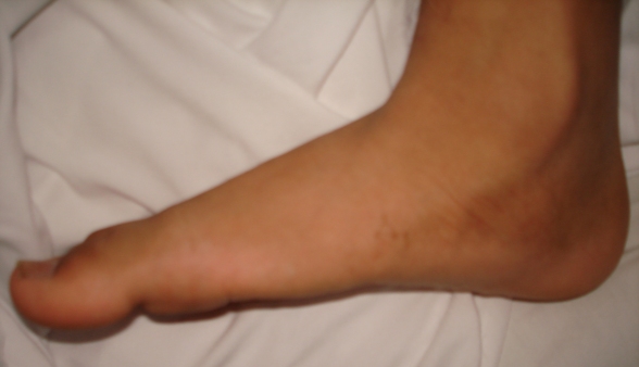 Flat foot with collapsed arch touching the ground